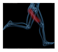 Sciatica