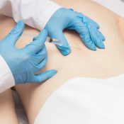 dry needling procedure