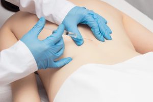 dry needling procedure